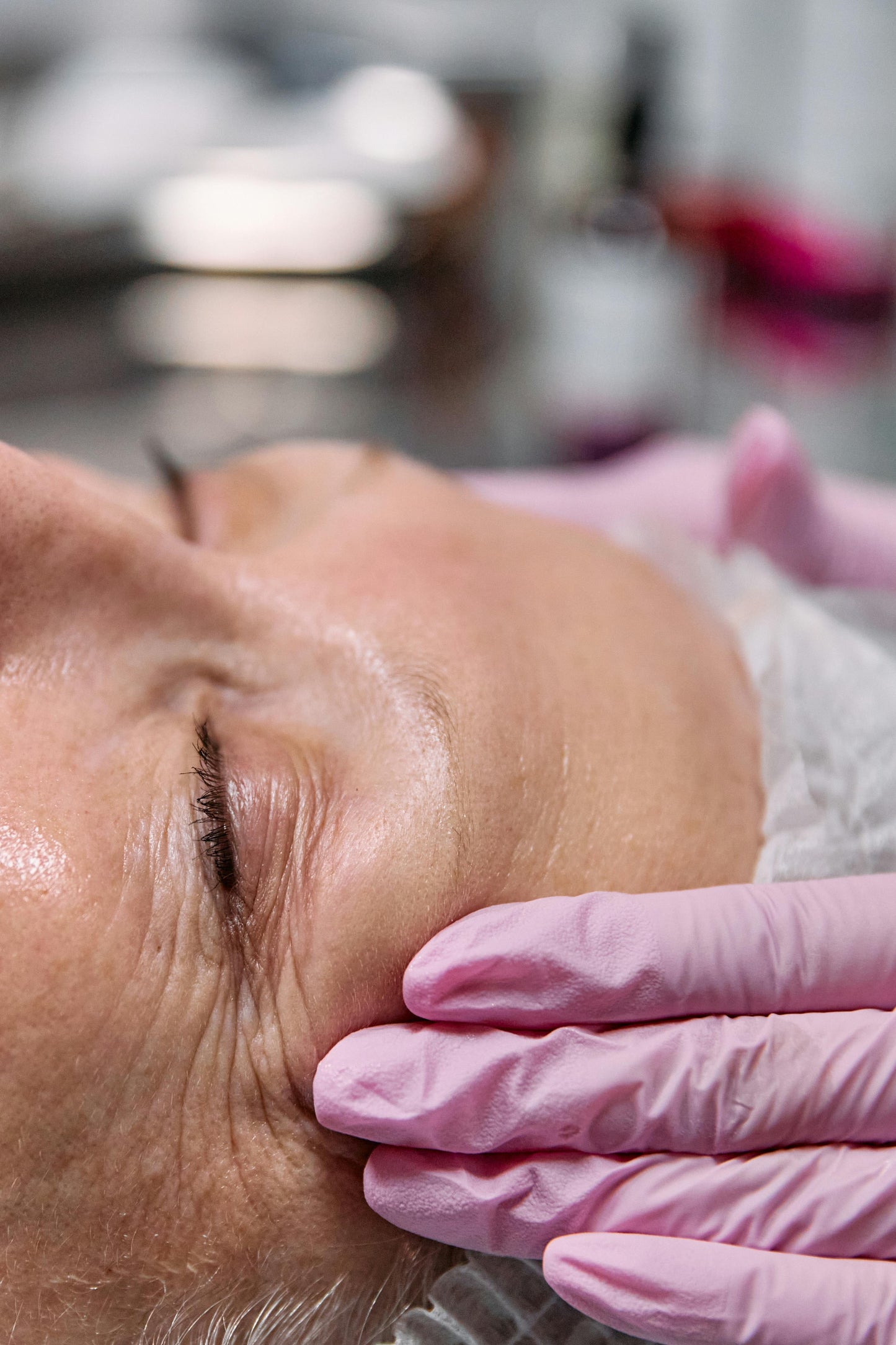 Eliminación de líneas de expresión facial