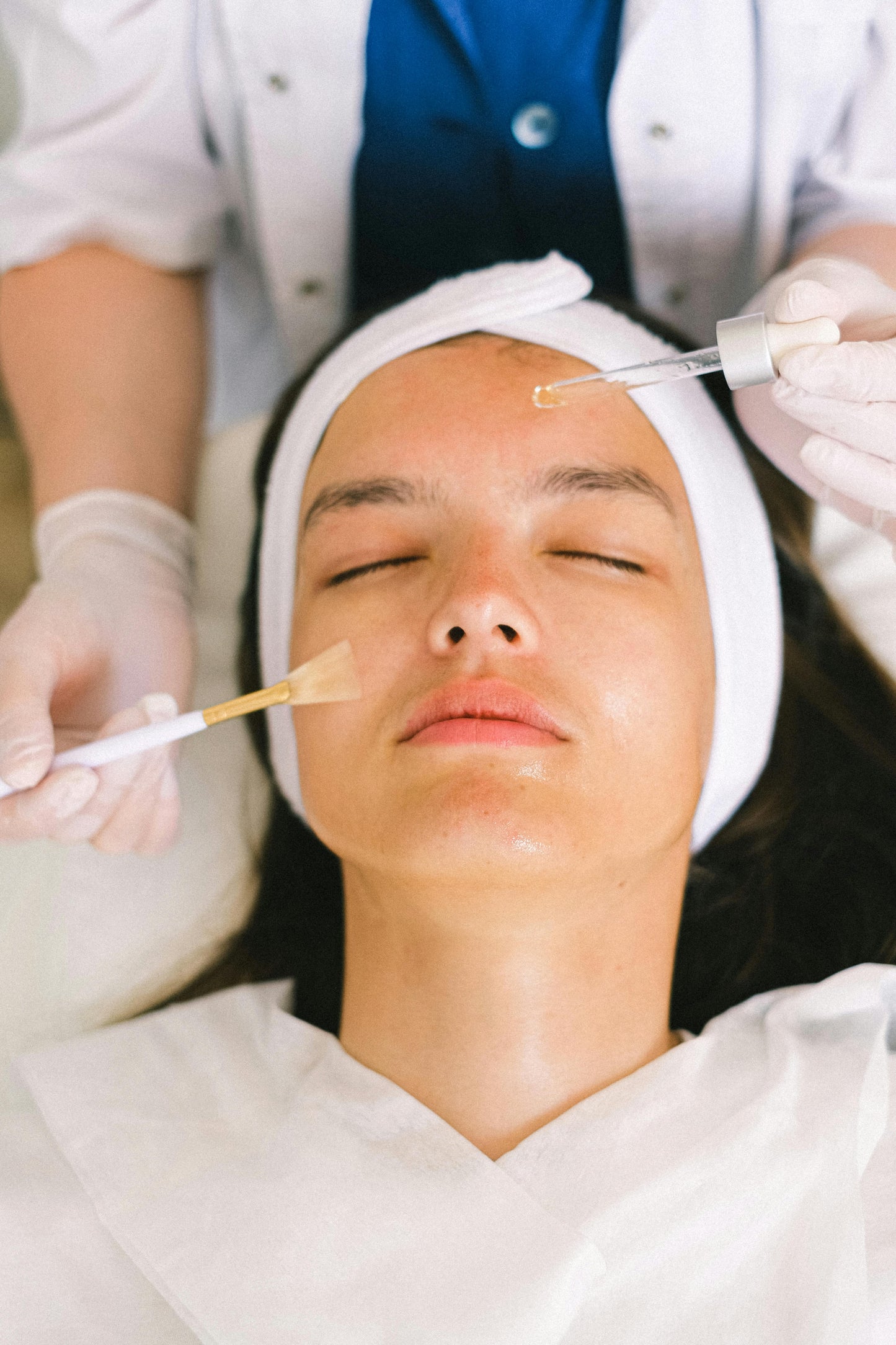 Mesoterapia facial para manchas, acné y estrías